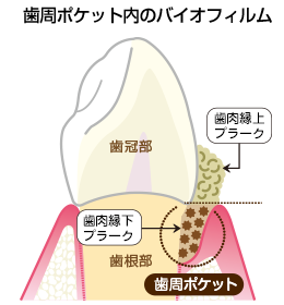 歯周病について