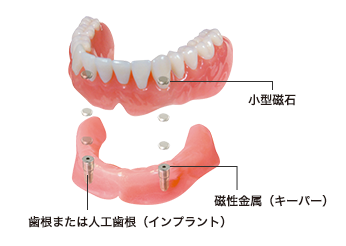 磁性アタッチメント義歯